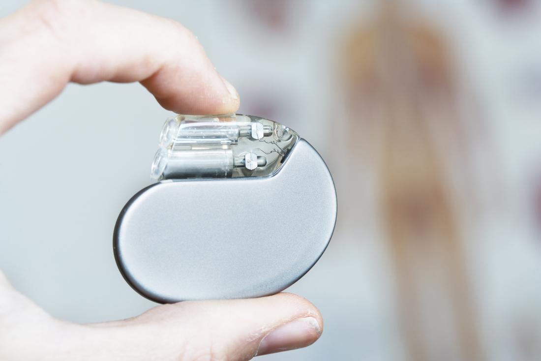 A doctor may recommend a pacemaker to treat bradycardia.