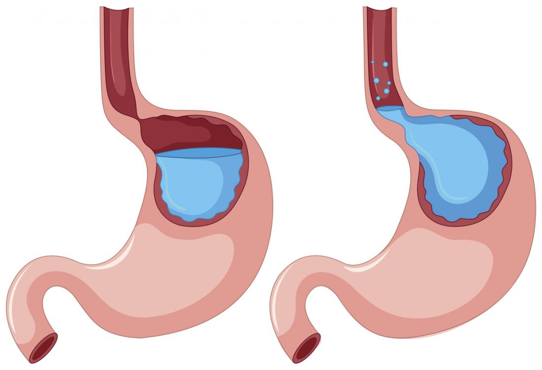 what does stomach acid look like