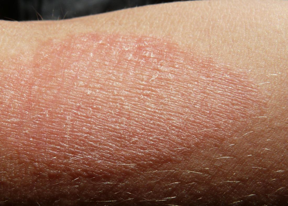 Eczema: Symptoms, treatment, and causes