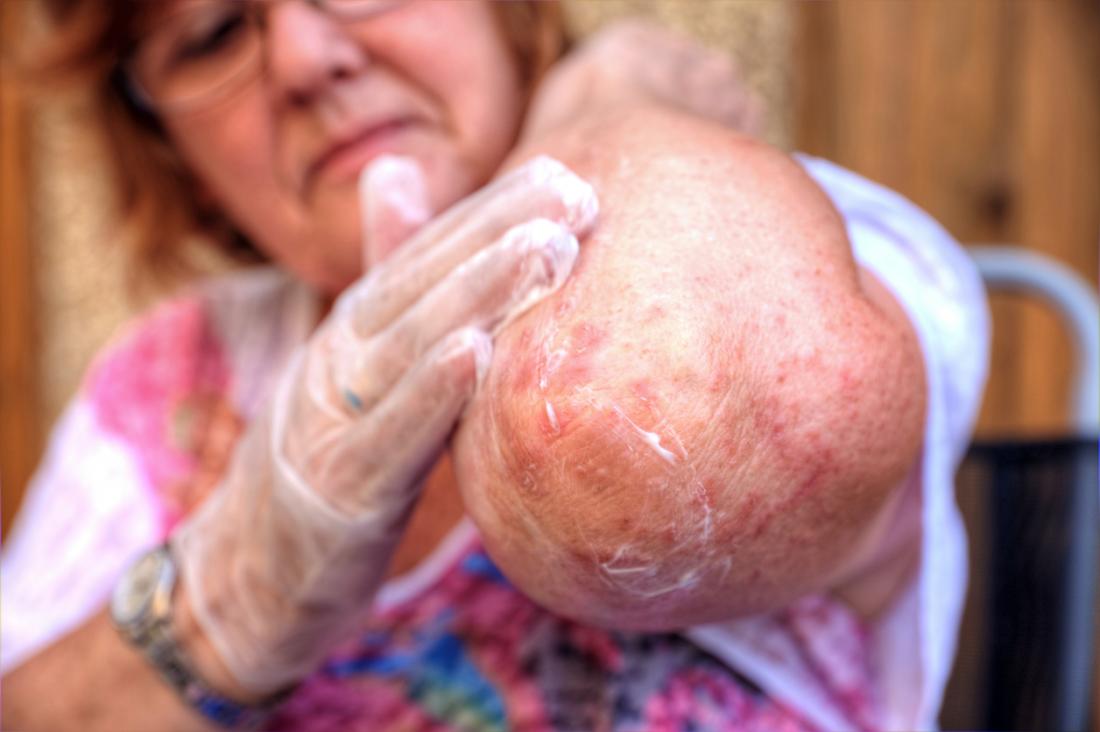 Woman rubbing cream onto eczema