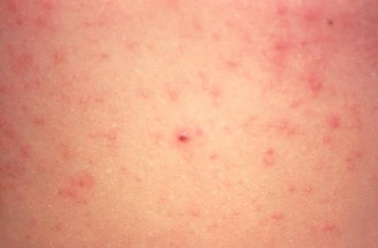 Scabies Images Symptoms And Treatments