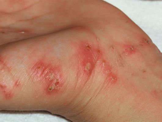 Scabies Images Symptoms And Treatments