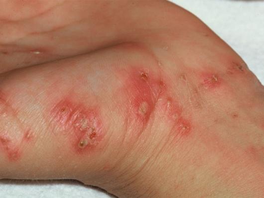 Scabies rash on hand