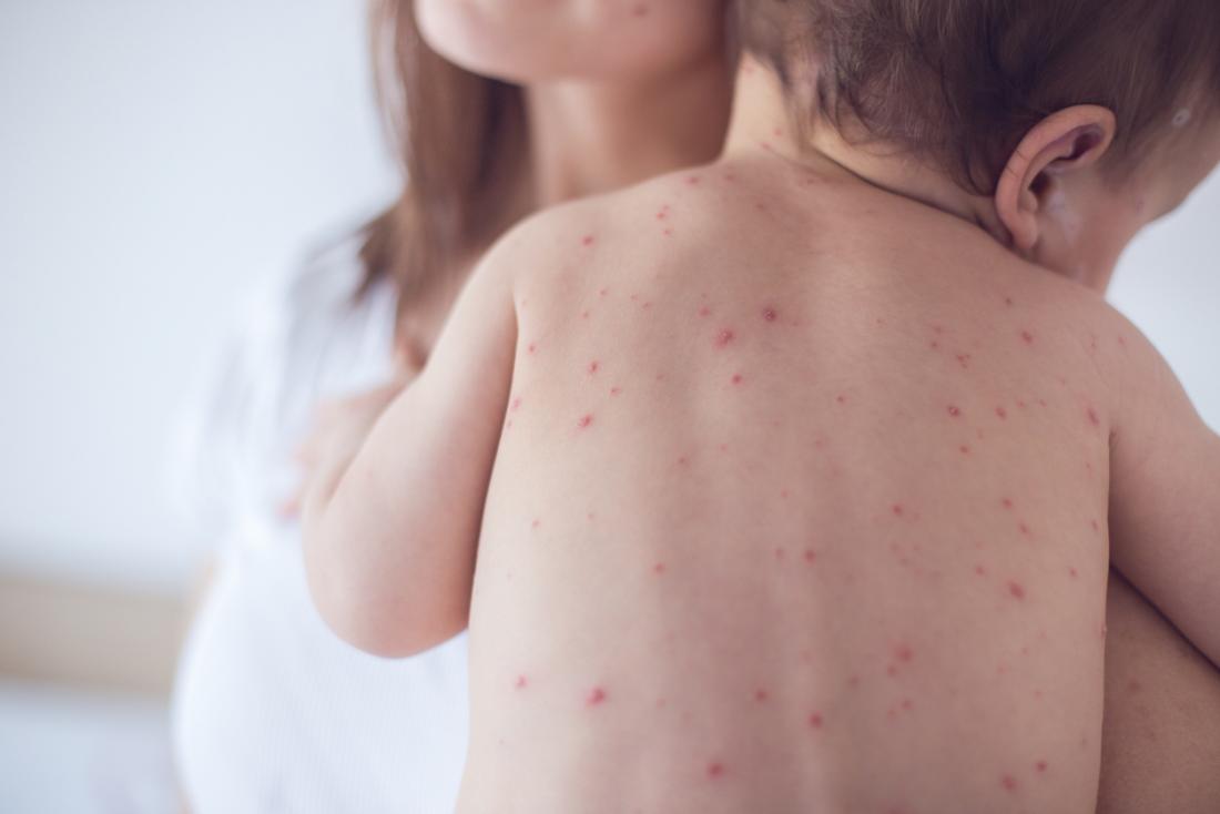 effects of measles on the body