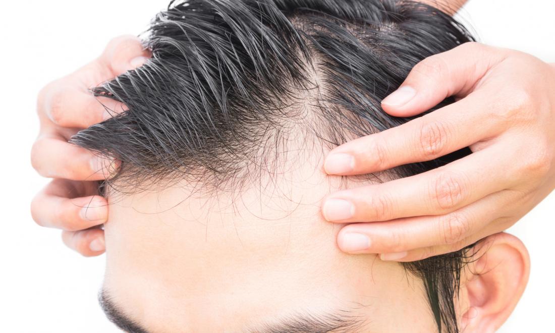 One male hair loss treatment works better than others study finds  CNN