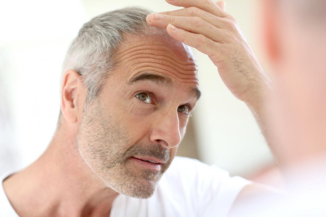 early male pattern baldness