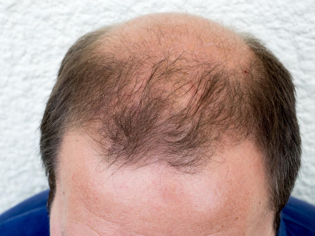 Nice Can Bald Guys Grow Hair Back for Thick Hair