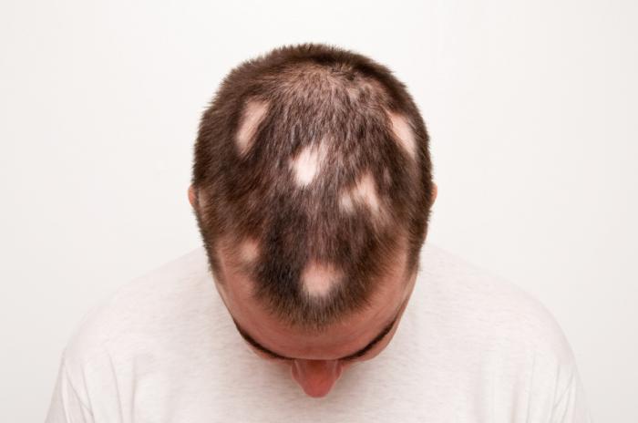 Alopecia Areata Causes Symptoms And Treatment