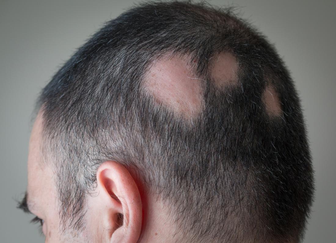 Symptoms of Alopecia Areata (Excessive Hair Loss, Bald Spots)