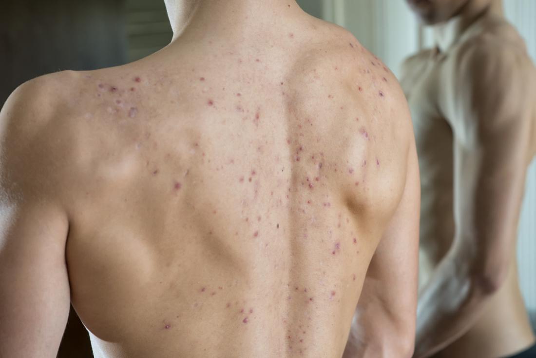 Blackheads, whiteheads, and cysts are all kinds of pimples, but what makes them break out?