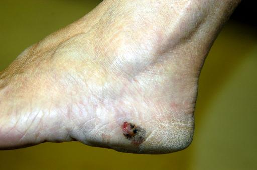 Malignant Melanoma Foot