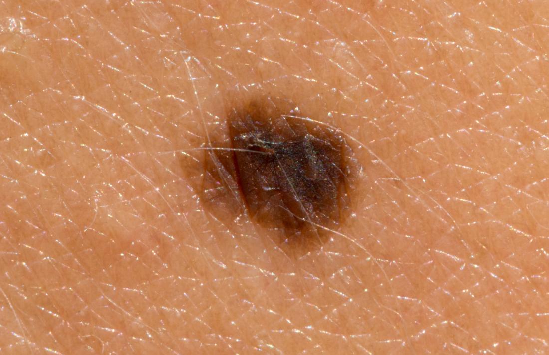 skin cancer