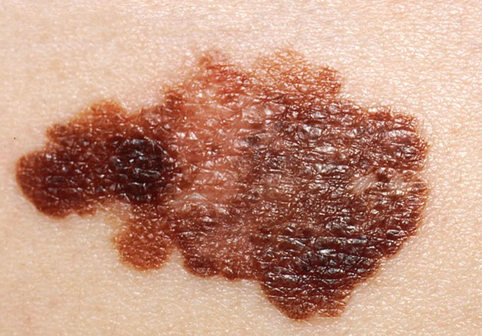 spreading melanoma image credit national cancer institute