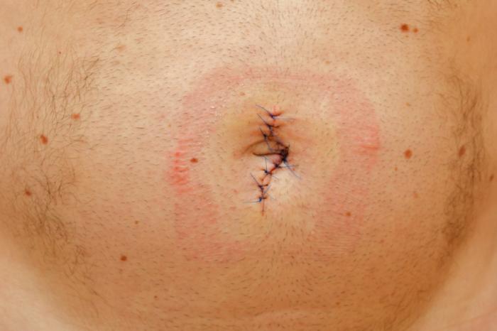 Umbilical hernia repair - series—Indications: MedlinePlus Medical