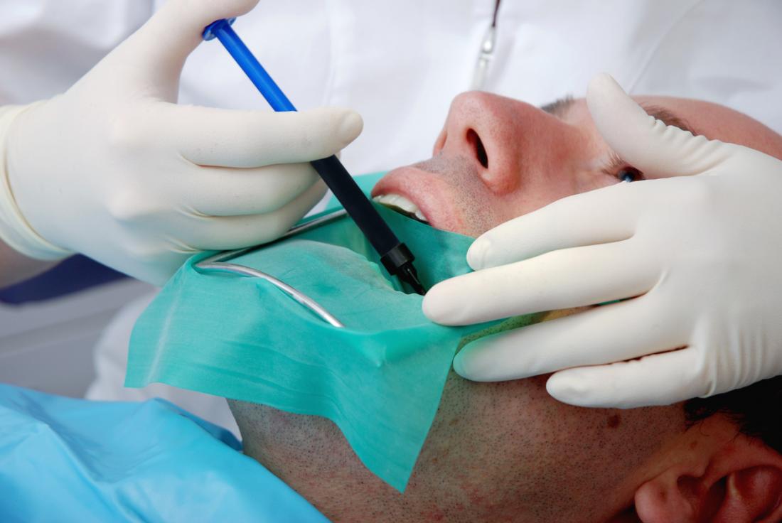 Root canal treatment: Everything you need to know