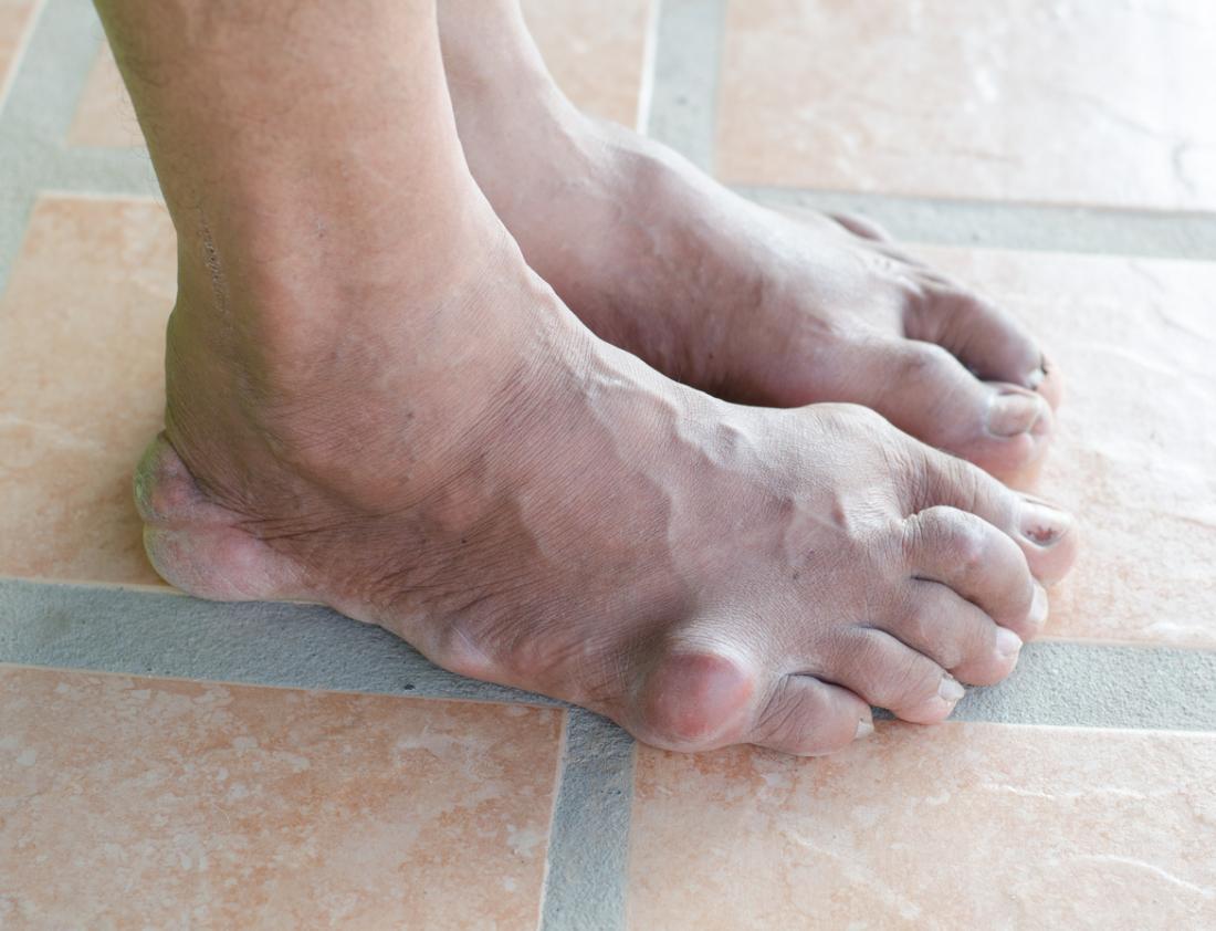 foot and heel gout