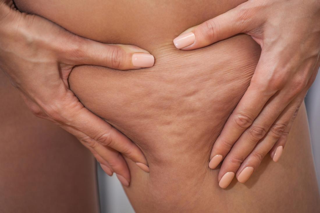Cellulite: Causes, treatment, and prevention