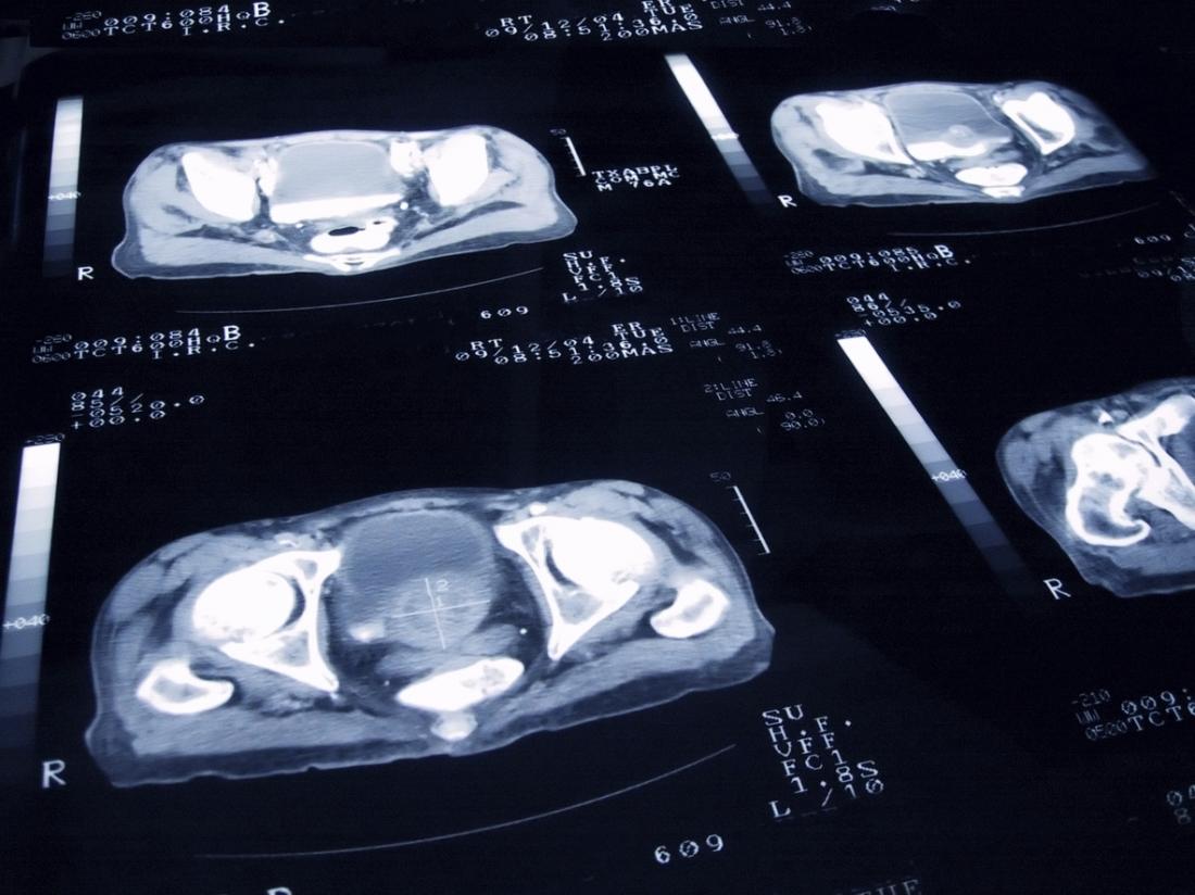 Imaging scans can show and track the presence of prostate cancer.