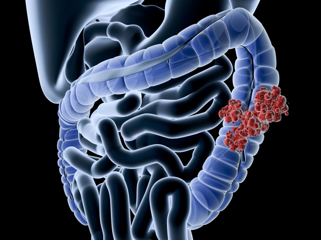 Colon cancer Symptoms, treatment, and causes