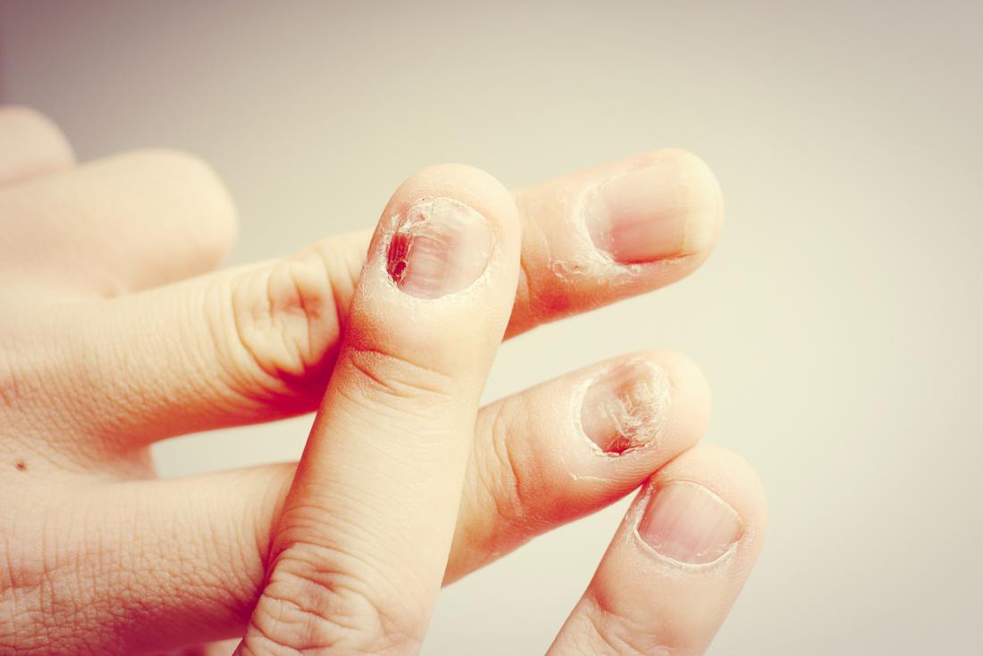 Nail fungal infection: Causes, treatment, and symptoms