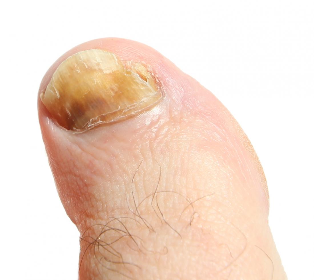 Fungal Infections as related to Nail fungus - Pictures