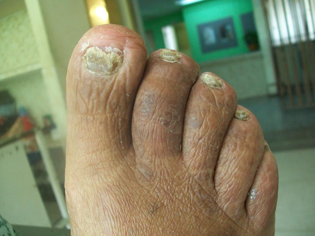 Onychomycosis (fungal nail infection)