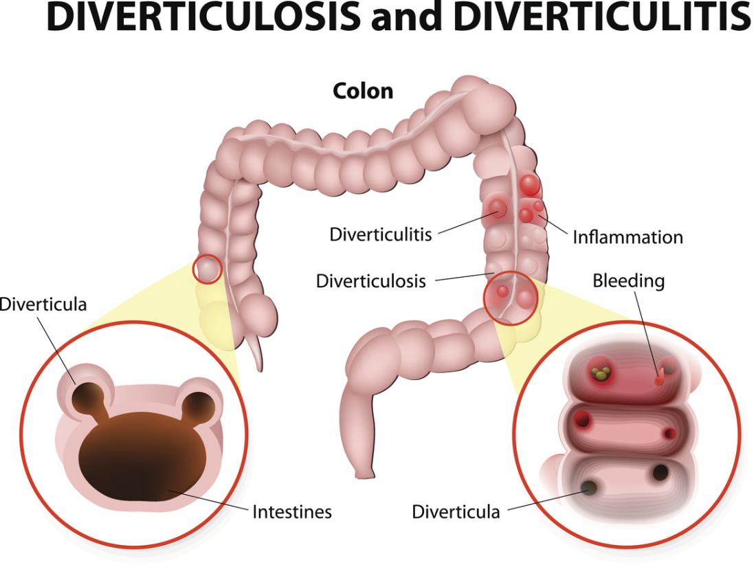 Diverticulitis Vs Diverticulosis Chart