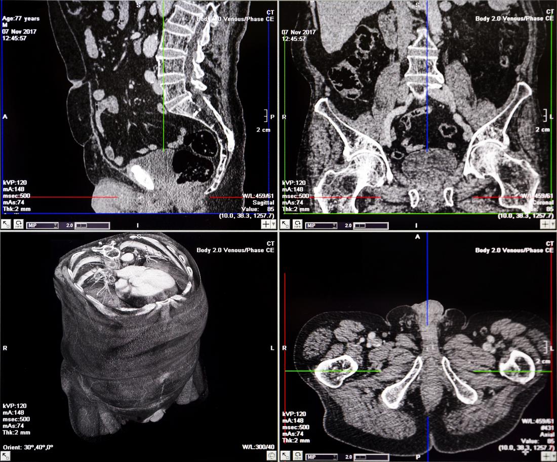 CT Scan Or CAT Scan How Does It Work 