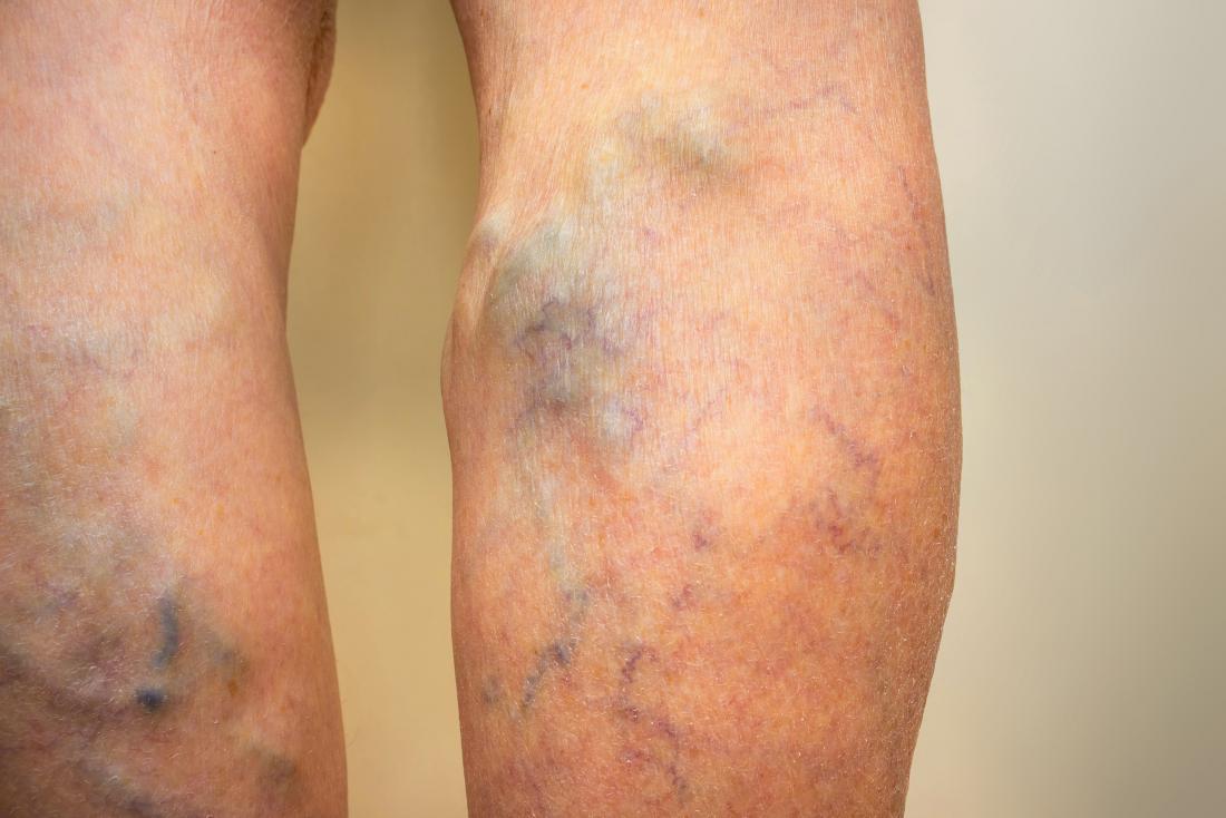 People with varicose veins