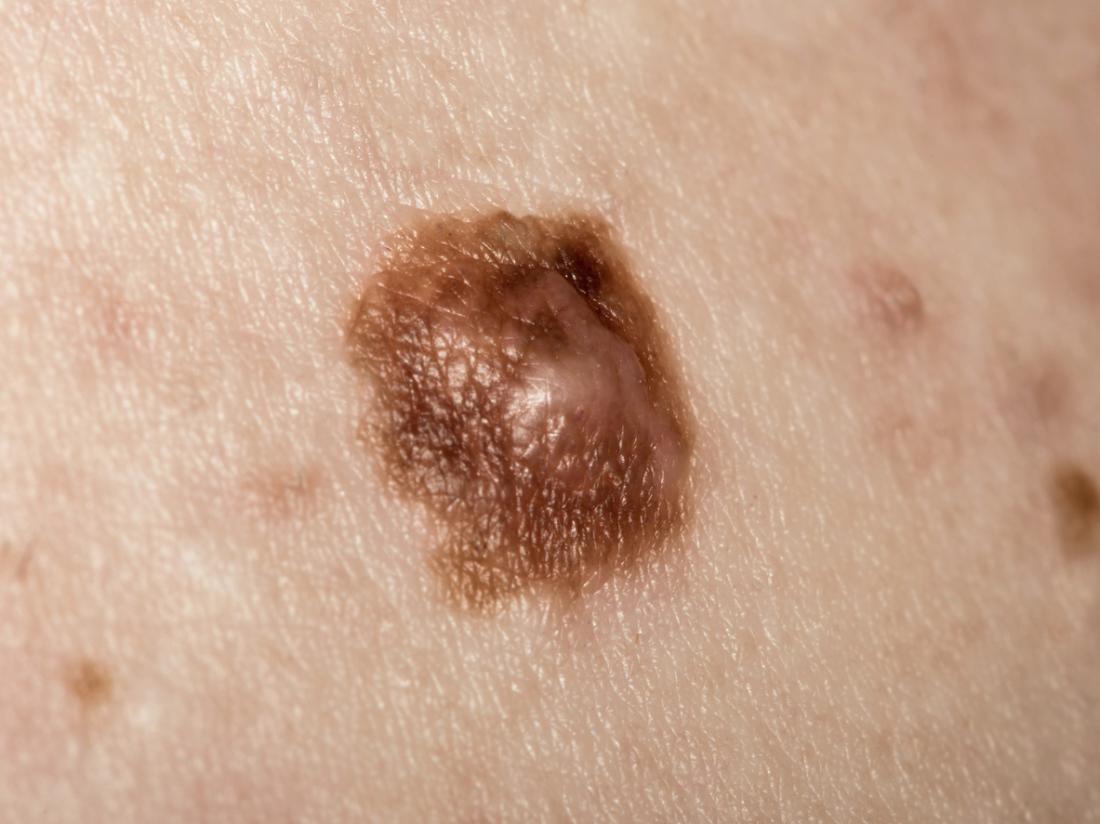 Melanoma Skin Cancer Image 