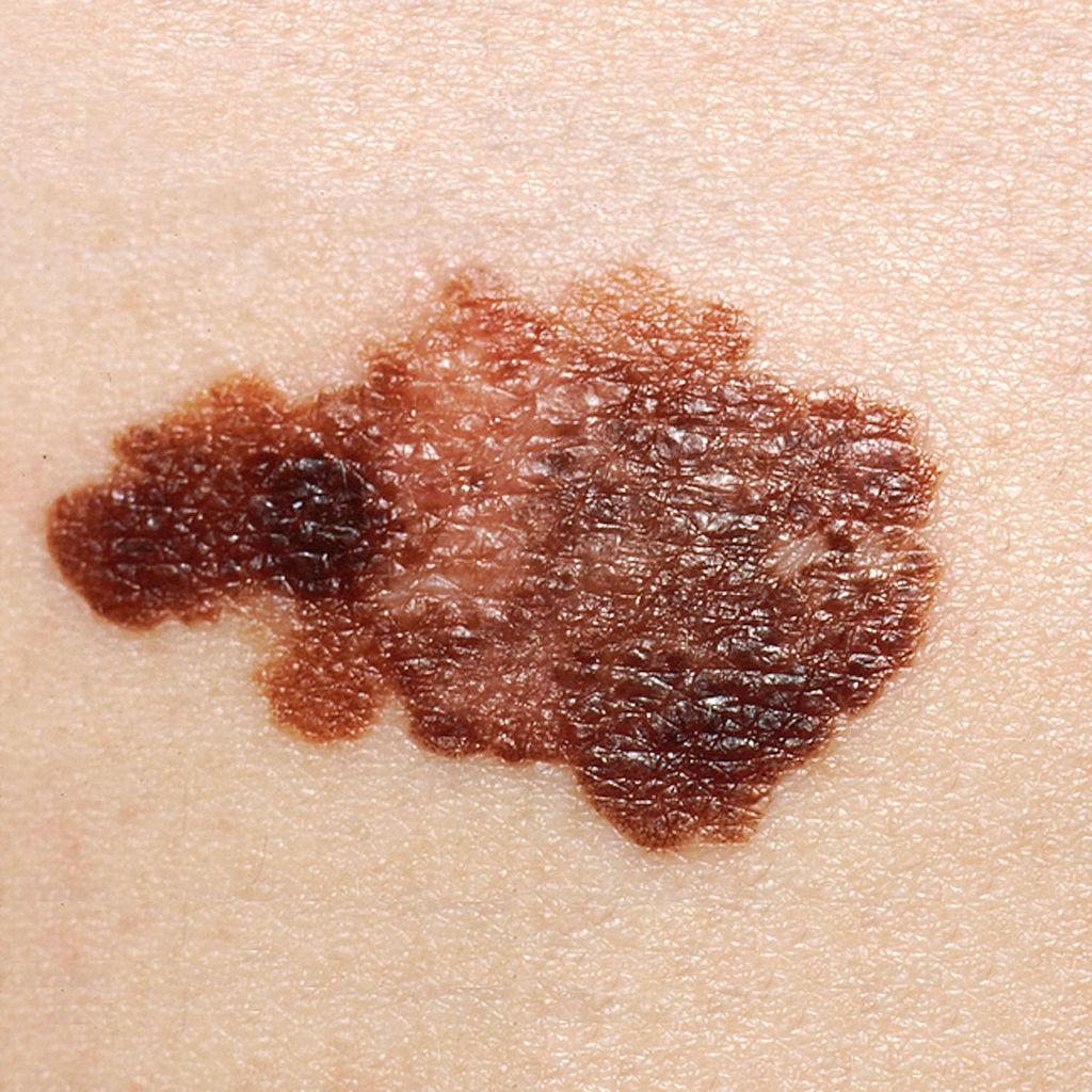 Superficial spreading melanoma. Image credit: National Cancer Institute