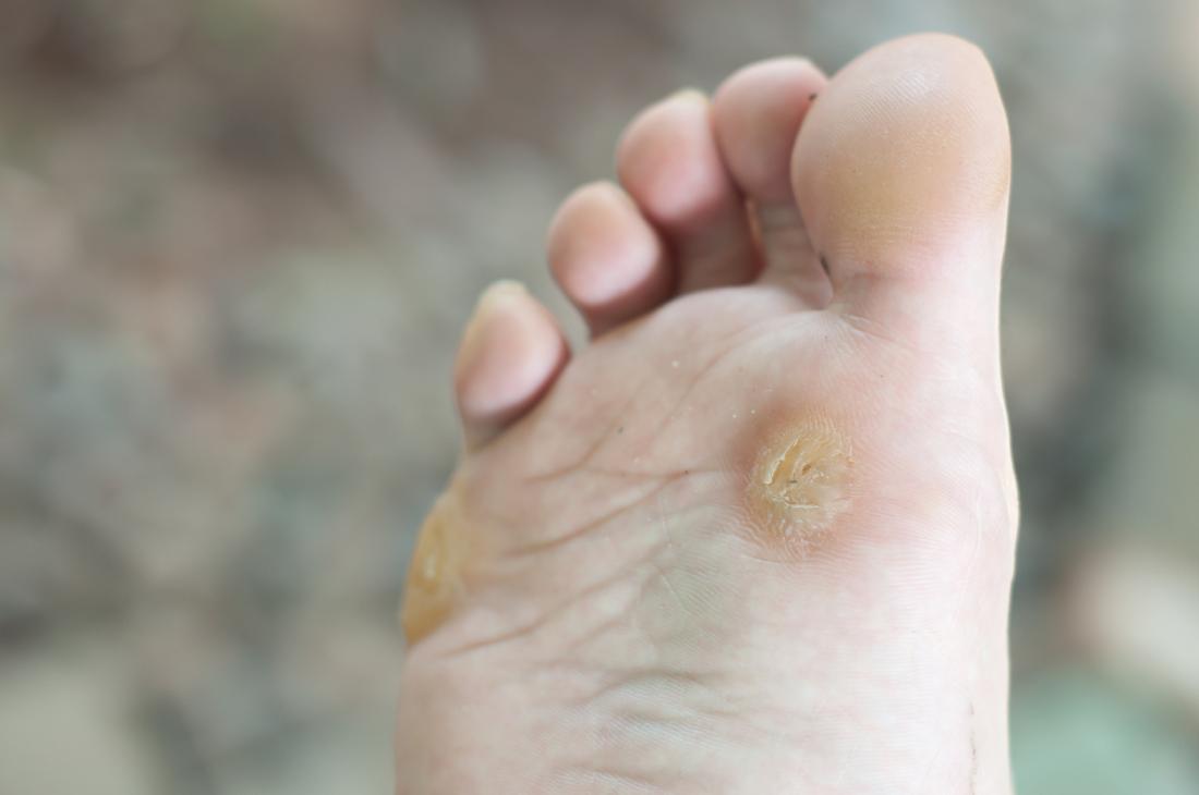 [Plantar warts]