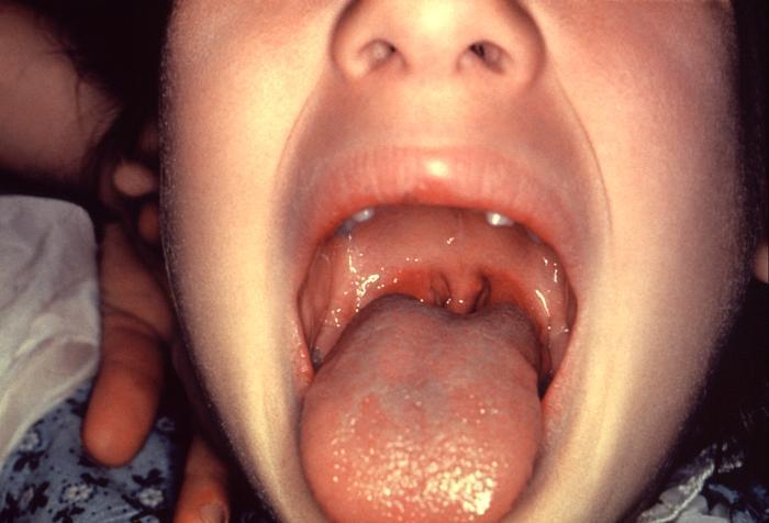 Strep Throat Causes Diagnosis And Treatments