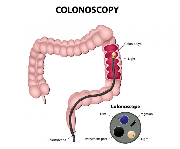 Signs And Symptoms Of Colon Cancer Recurrence CancerWalls