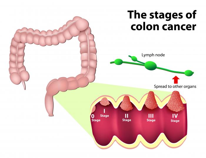 Stages Of Colorectal Cancer