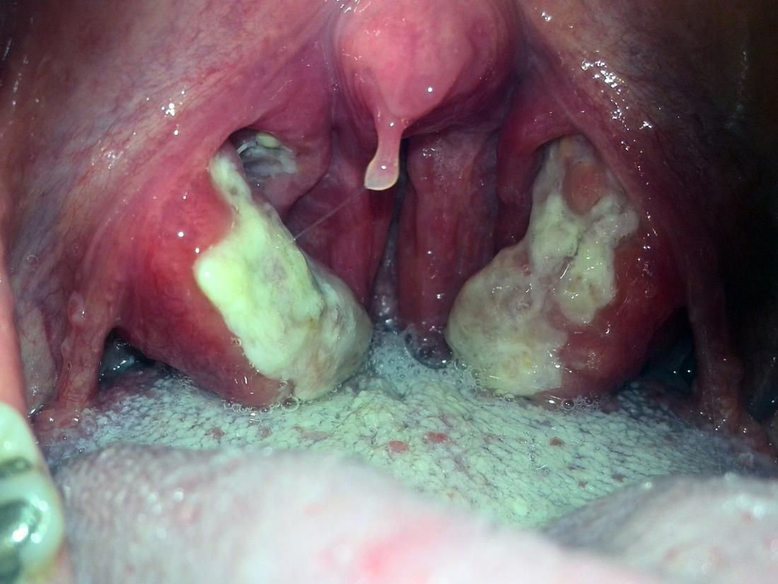 severe tonsil infection