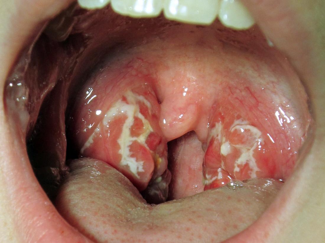 tonsillitis treatment at home