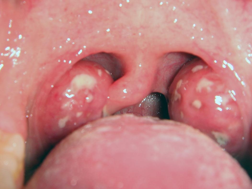 normal tonsils vs infected tonsils