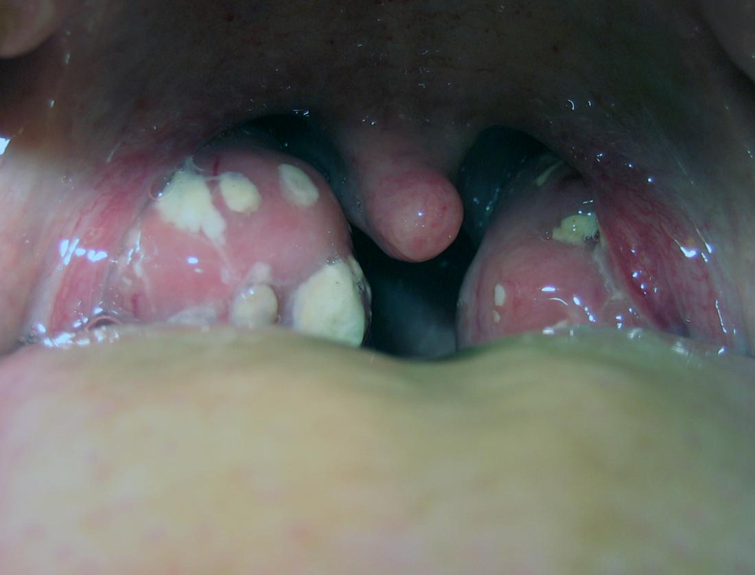 oral chlamydia tonsils