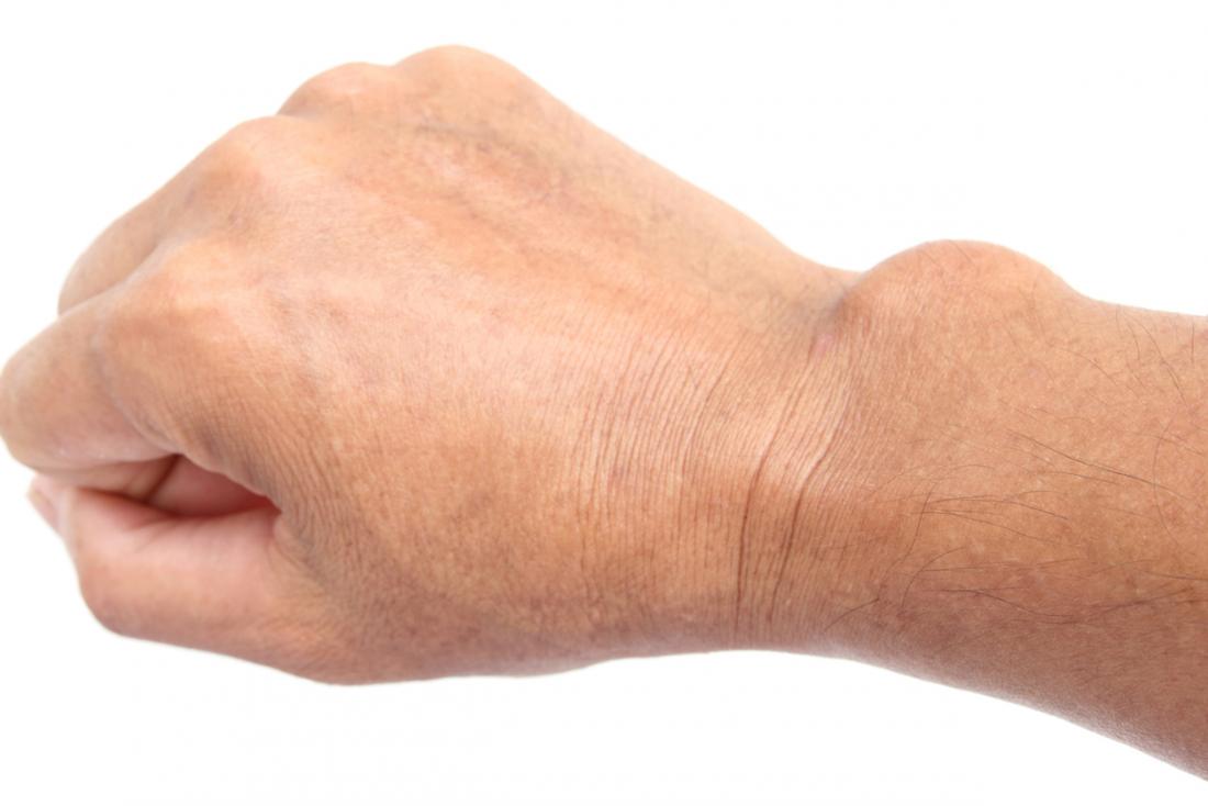 ganglion-cyst-symptoms-causes-and-treatment