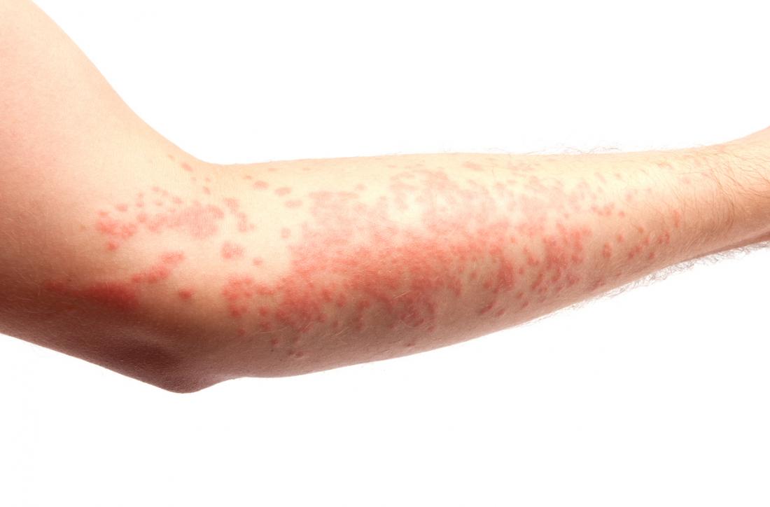 Hives (urticaria): Causes, treatment, and symptoms