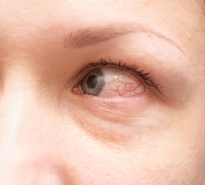 Allergic Conjunctivitis Treatment Symptoms And Causes