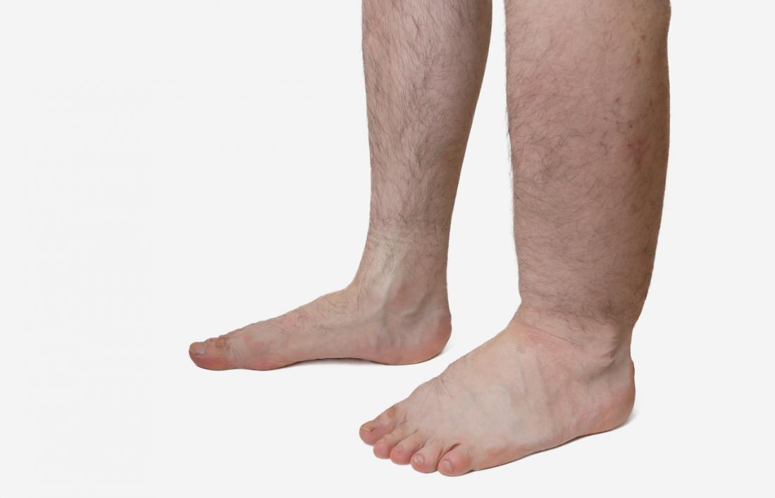 Edema, or water retention, causes a part of the body to swell.