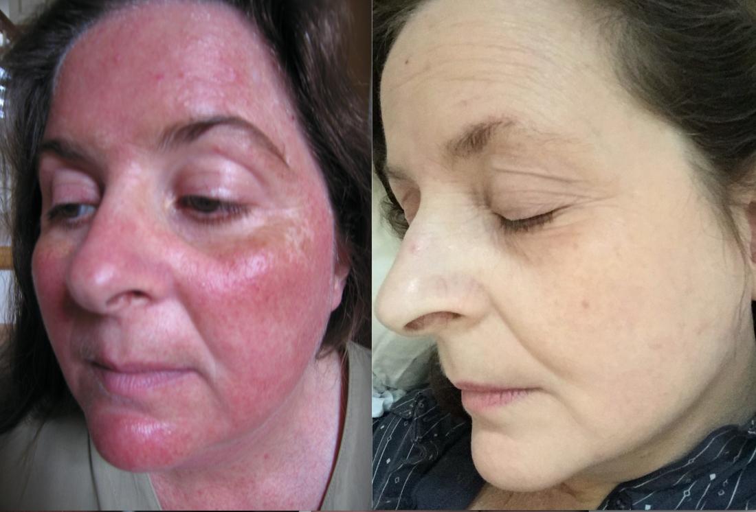 Steroid rosacea, <br>Image credit: Corinna Kennedy own work 2017 https://upload.wikimedia.org/wikipedia/commons/d/d9/Steroid_Rosacea.jpg