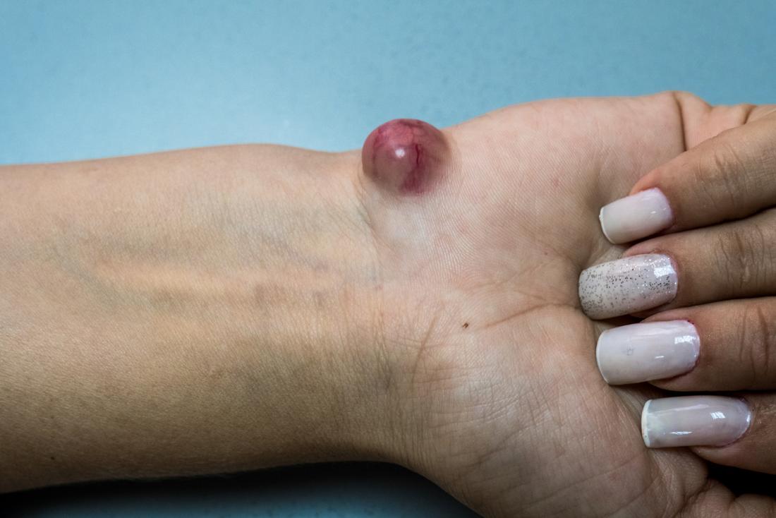 Cyst on wrist