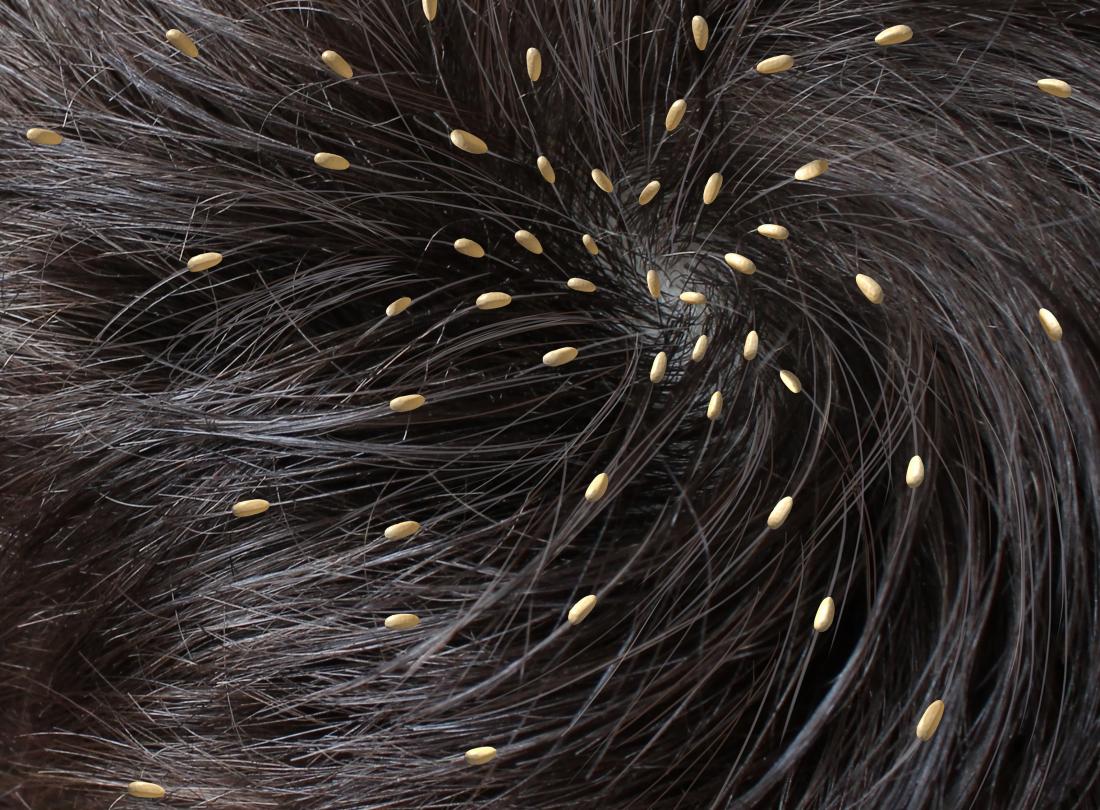 Head lice: Causes, symptoms, and treatments