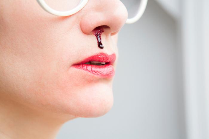 Nosebleeds Causes Treatment And Home Remedies