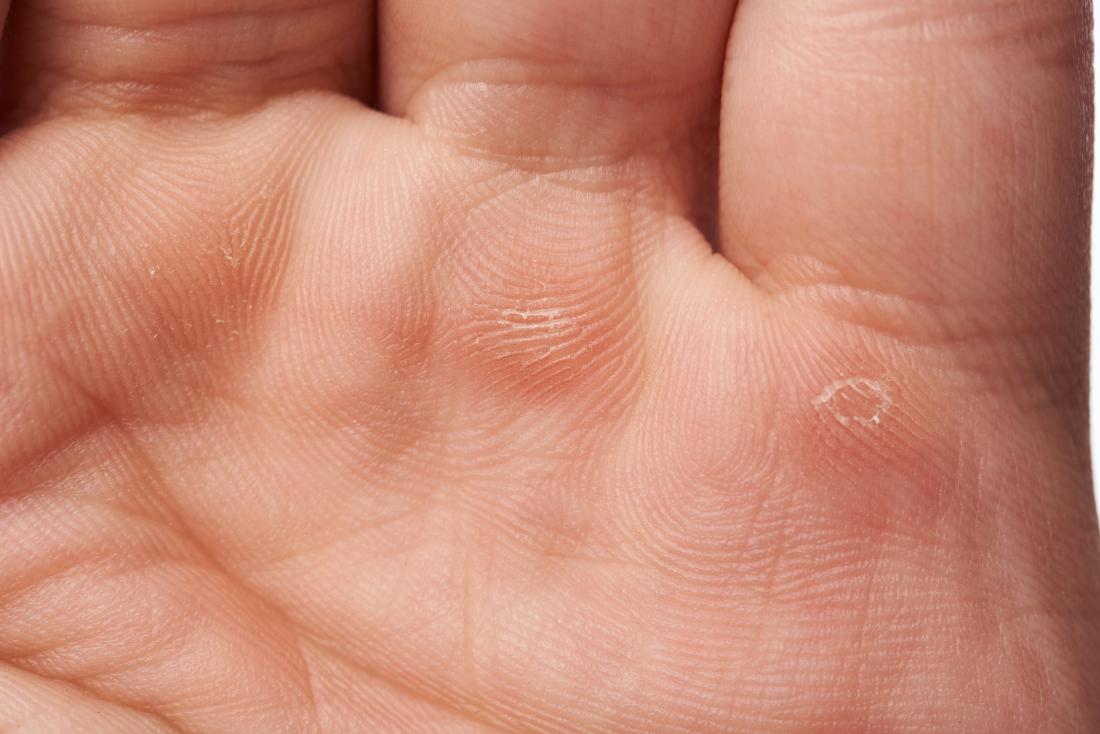 skin blisters