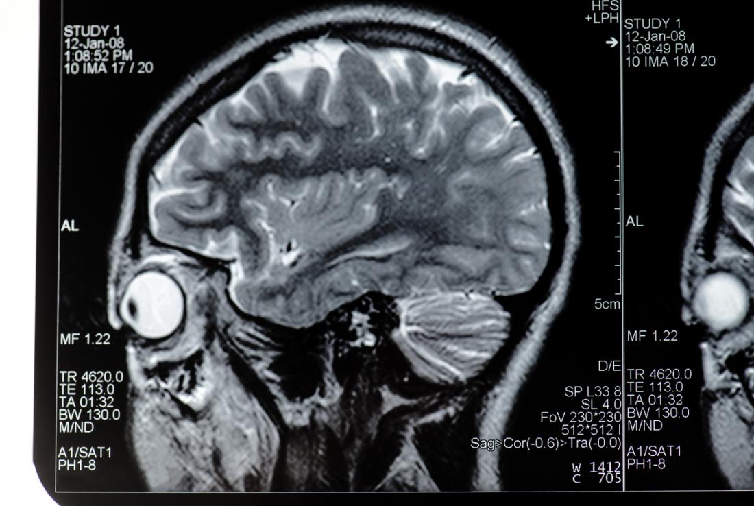 MRI scan head brain eye