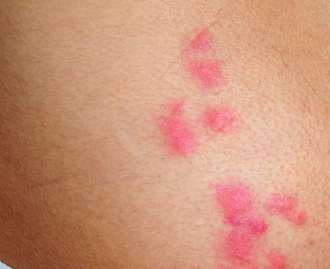 cluster of bug bites that itch